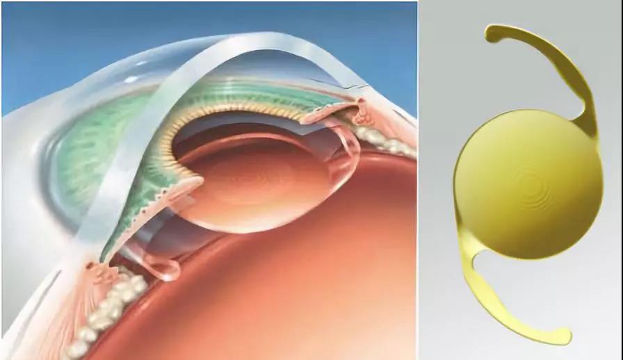 硬性人工晶体应用于临床的时间较长,由于价格相对便宜,早期许多患者