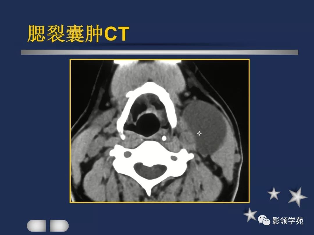 下至下頜角,是莖突前咽旁間隙重要器官腮腺解剖淋巴結腫大性疾病頸