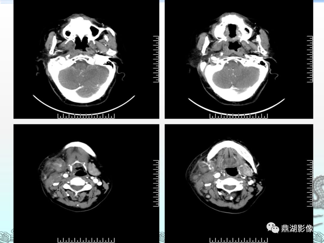 鼻咽癌的ct诊断与鉴别诊断