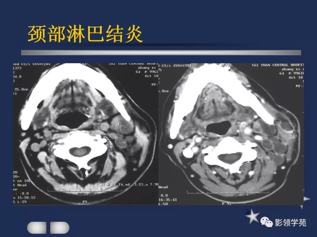 下至下頜角,是莖突前咽旁間隙重要器官腮腺解剖淋巴結腫大性疾病頸