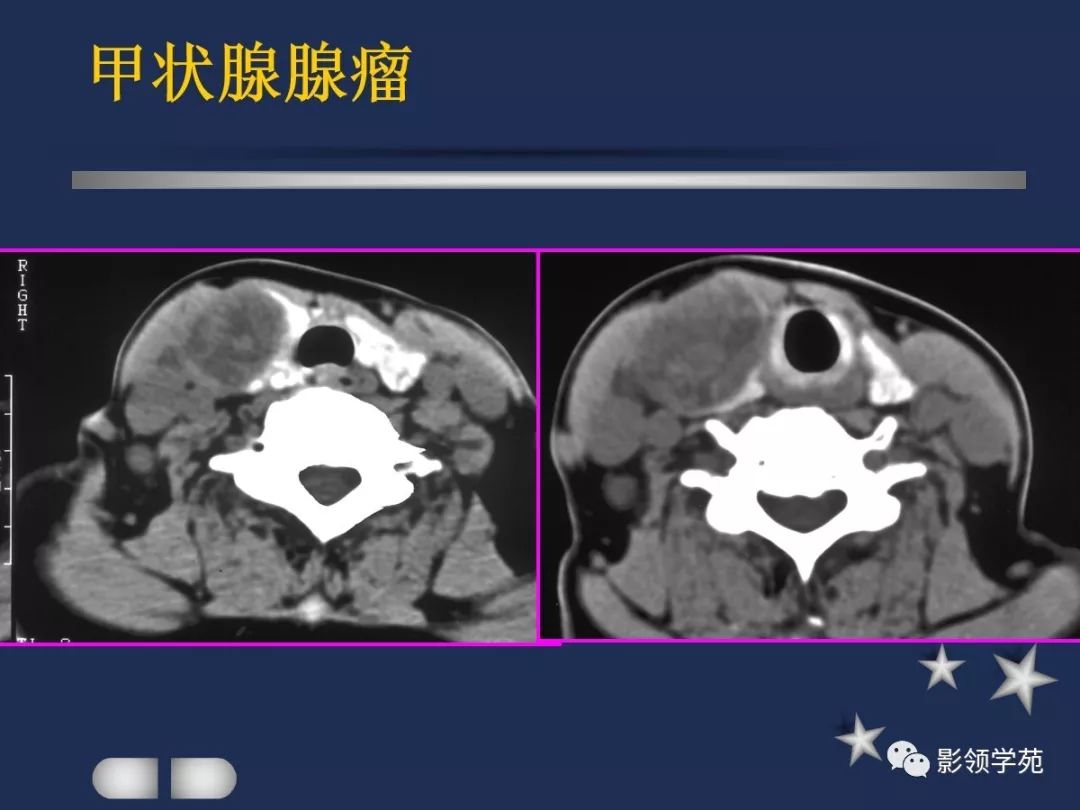 腮腺,頸部疾病影像診斷_淋巴結