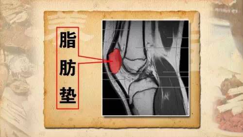 有老百姓所说的筋疙瘩形成这种筋疙瘩中医称作筋结