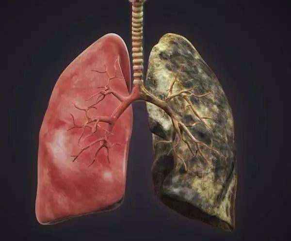 长期抽烟人的肺部图片图片