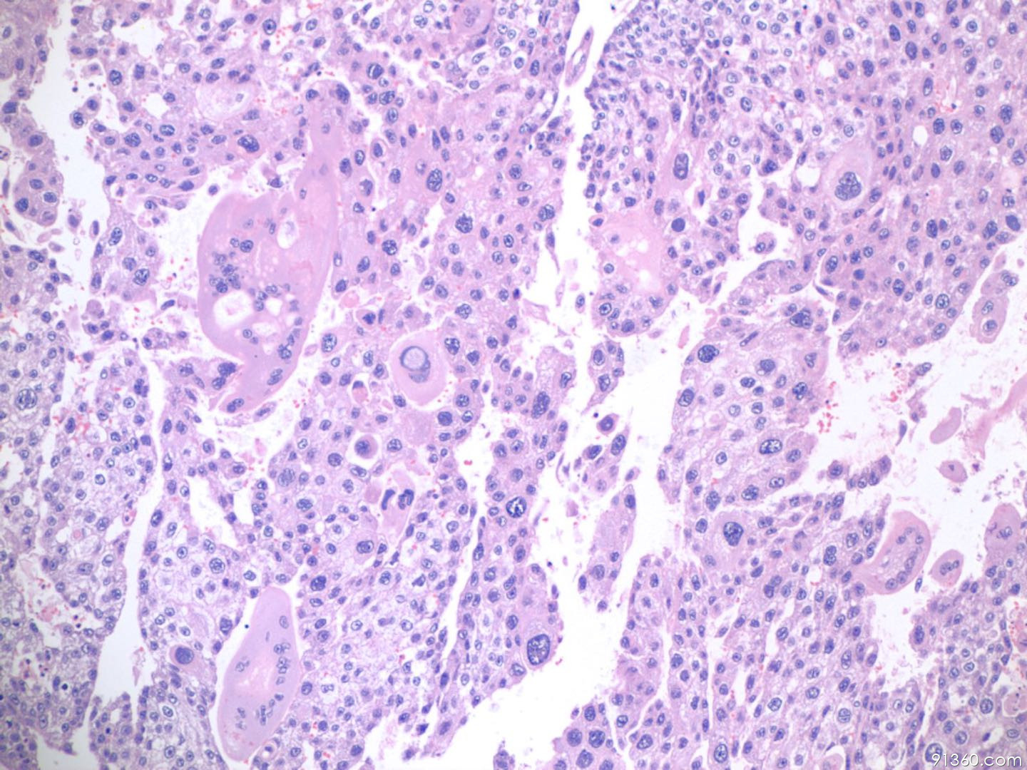 病理沙龙妊娠滋养细胞肿瘤完全性葡萄胎