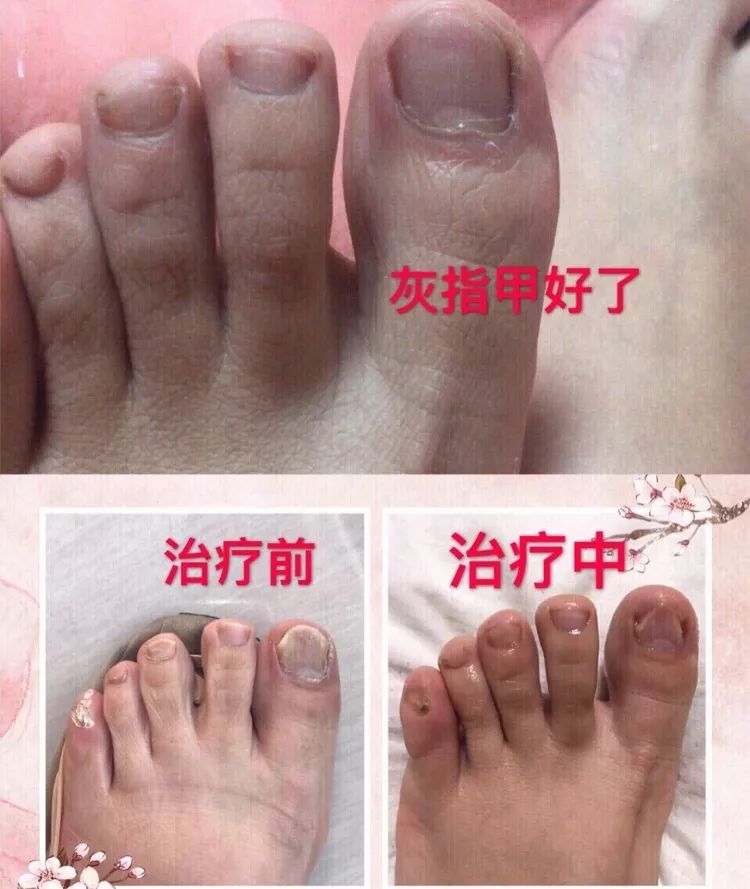 结果没想到,用了一段时间后,指甲竟然恢复了健康状态.