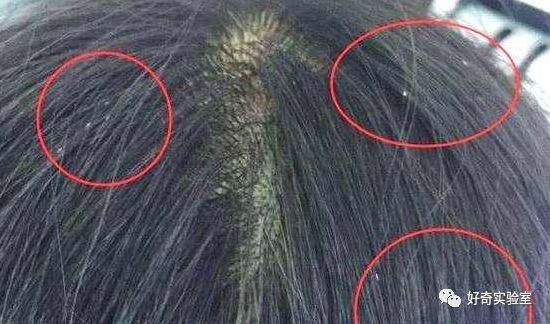 管状的它们和常见的头皮屑不一样仔细观察就会发现必须要用手一颗一颗