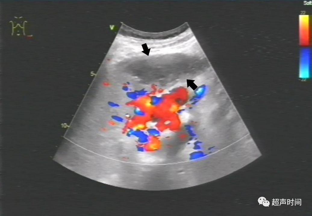 脾静脉超声图图片
