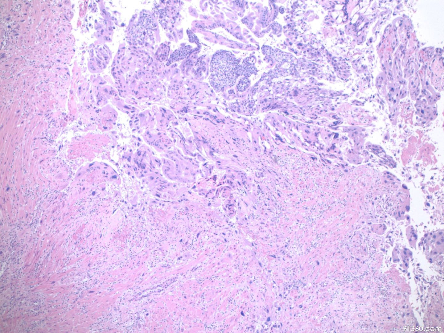 病理沙龙妊娠滋养细胞肿瘤完全性葡萄胎