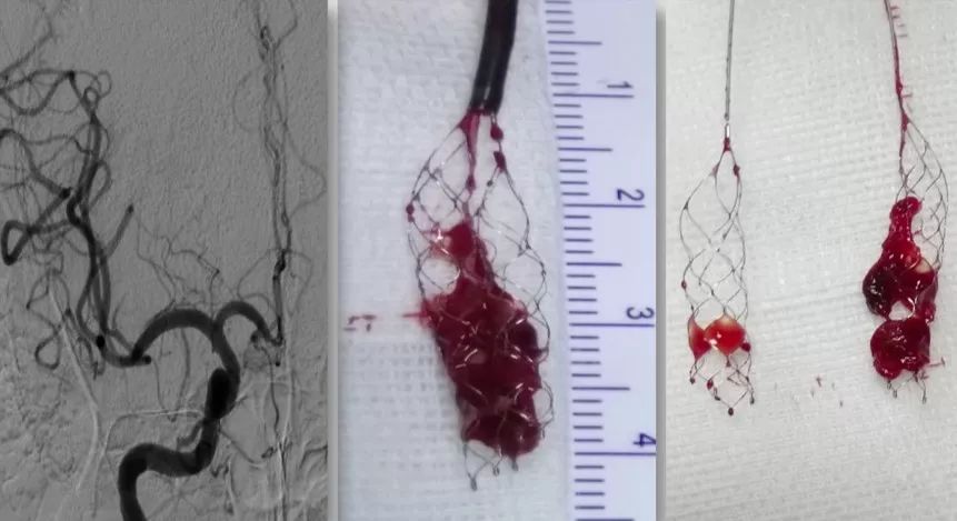 黄金波教授大脑中动脉分叉部solitaire双支架夹栓术再通一例