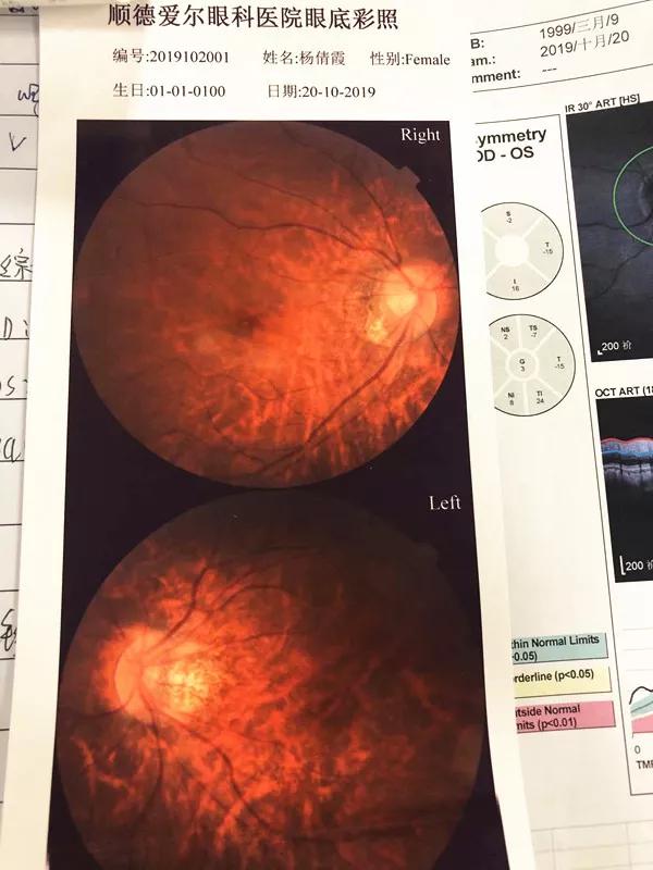 另外,近视防控科刘主任为高度近视患者做眼底检查,发现双眼视网膜出现