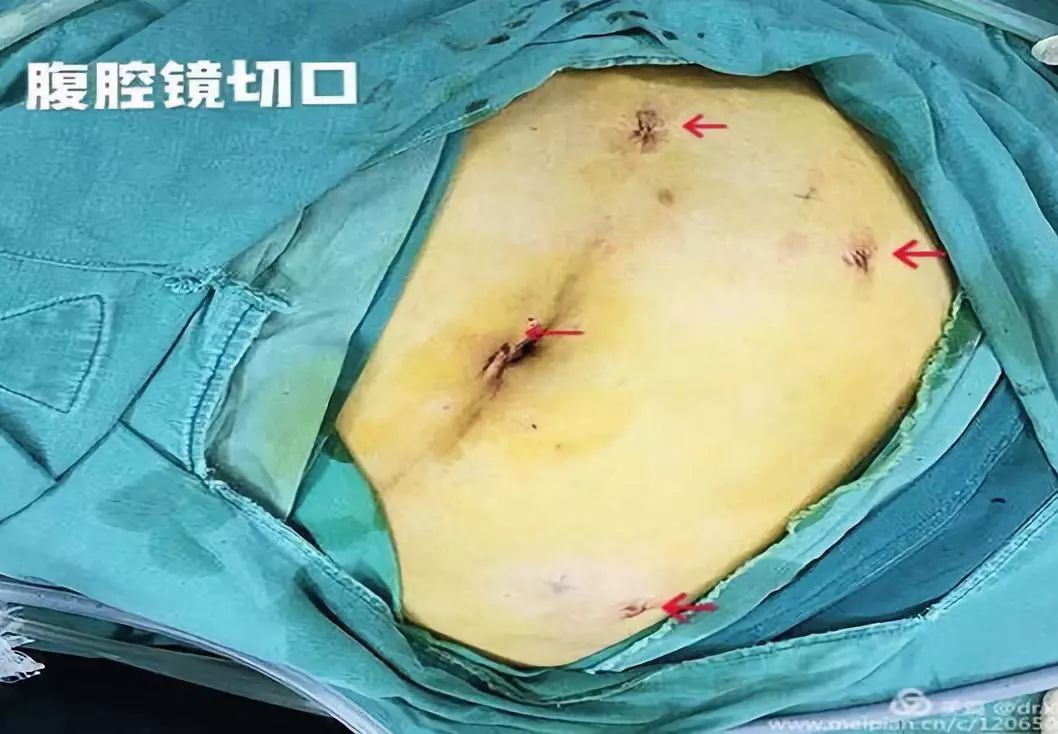 淄博市中医医院妇产科熟练开展各种妇科腹腔镜手术
