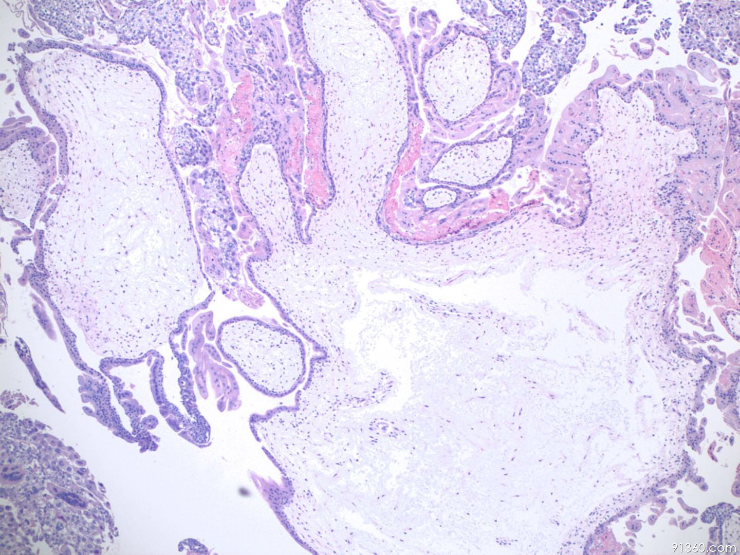 病理沙龙妊娠滋养细胞肿瘤完全性葡萄胎
