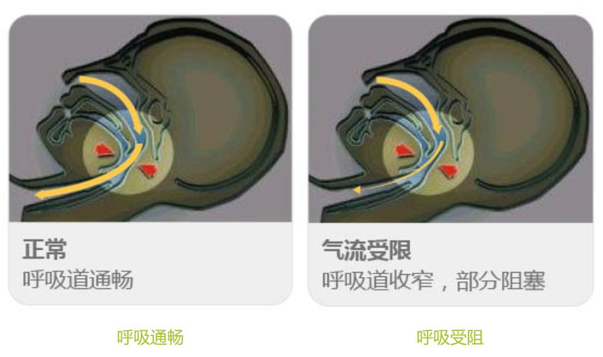 世界开始关注打鼾造成的危害!_睡眠