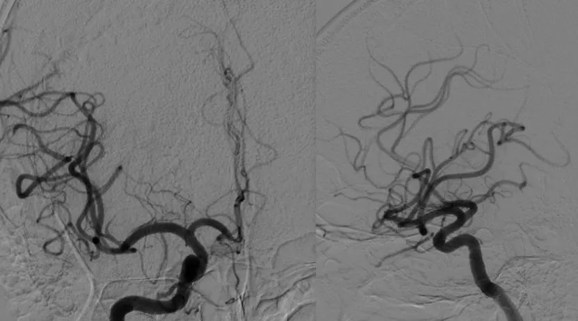 黄金波教授大脑中动脉分叉部solitaire双支架夹栓术再通一例