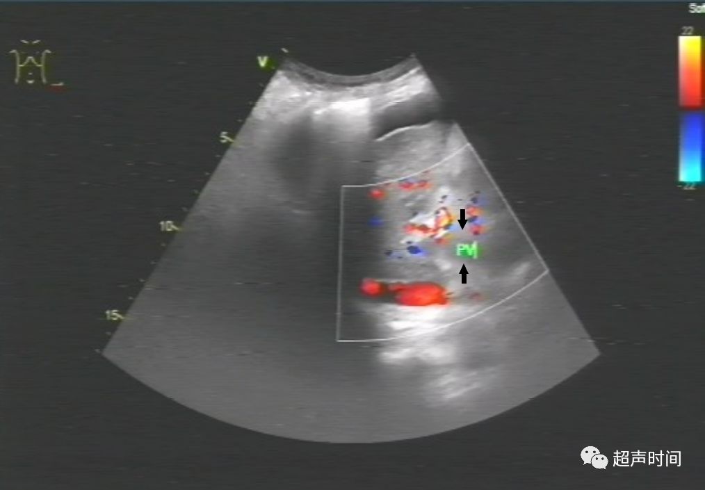 脾梗死典型和不典型的超聲表現
