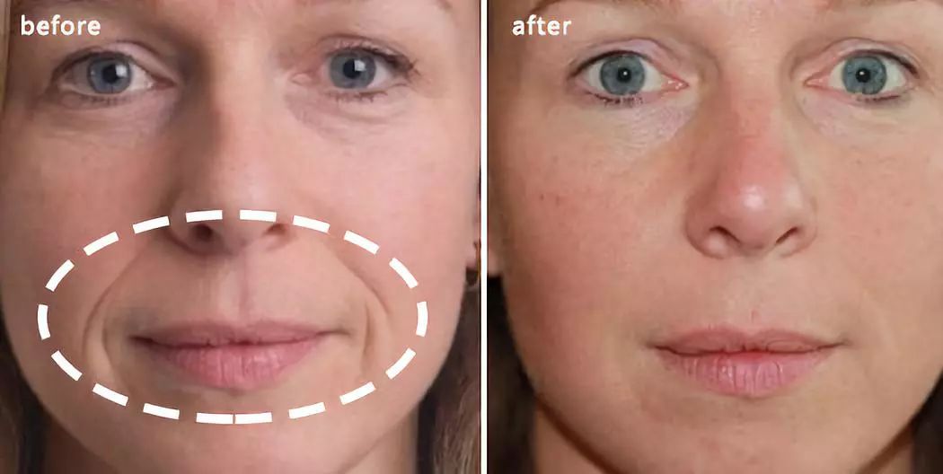 法令纹眉间纹又凶又老贴上它一觉醒来胜过10次除皱针