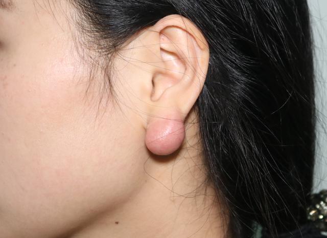 是打耳洞后耳朵眼长期不能愈合,甚至发炎反复感染从而形成疤痕疙瘩