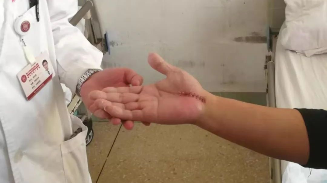 男子手指触觉完全消失只因一个常见动作造成