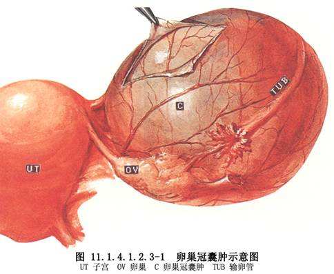 卵巢良性肿瘤图片
