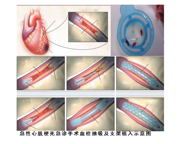 將於11月30日親臨新餘第四醫院為廣大心腦血管患者親診,手術,請相互