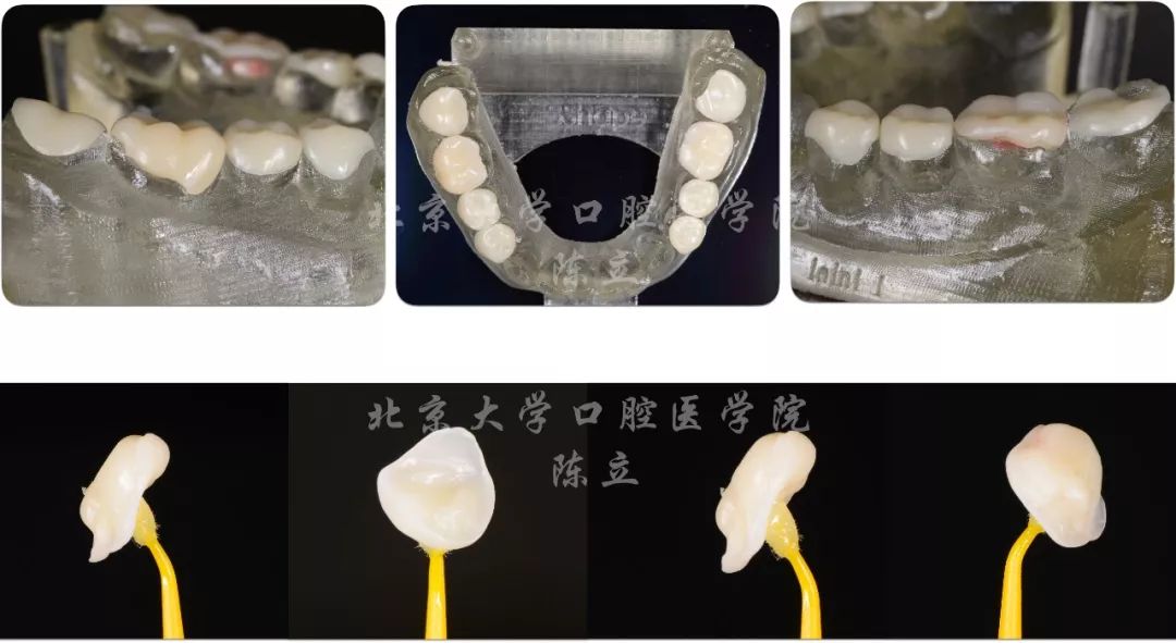 病例混合型貼面一例