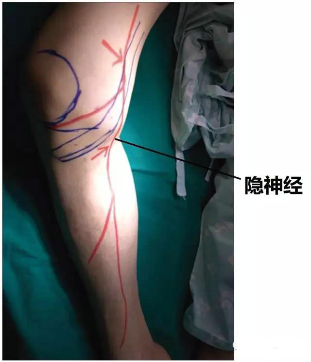 体表神经解剖隐神经