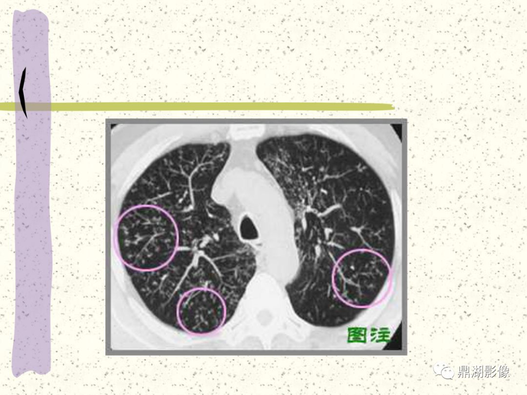 肺弥漫性微小结节的诊断与鉴别诊断