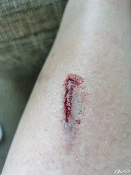 于谦国外遇事故,小腿伤口露骨头,德云社弟子却争相调侃?