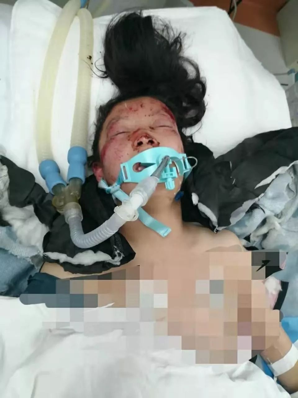 张北两名小女孩出车祸,生命垂危!