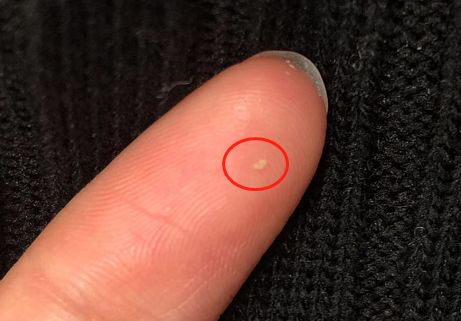 结果检测之后,头发发根的毛囊口都被油脂堵得严严实实,全是颗粒状的