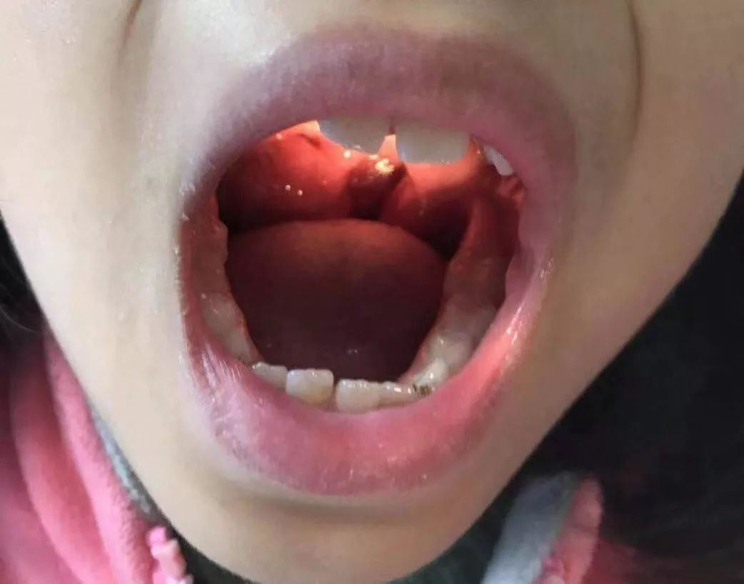 她的妈妈带她来看扁桃体肿大,张嘴一看,扁桃体果然已经三度肿大了上周