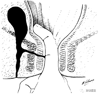 医学干货︱史上最全的肛瘘分类(锋哥推荐!