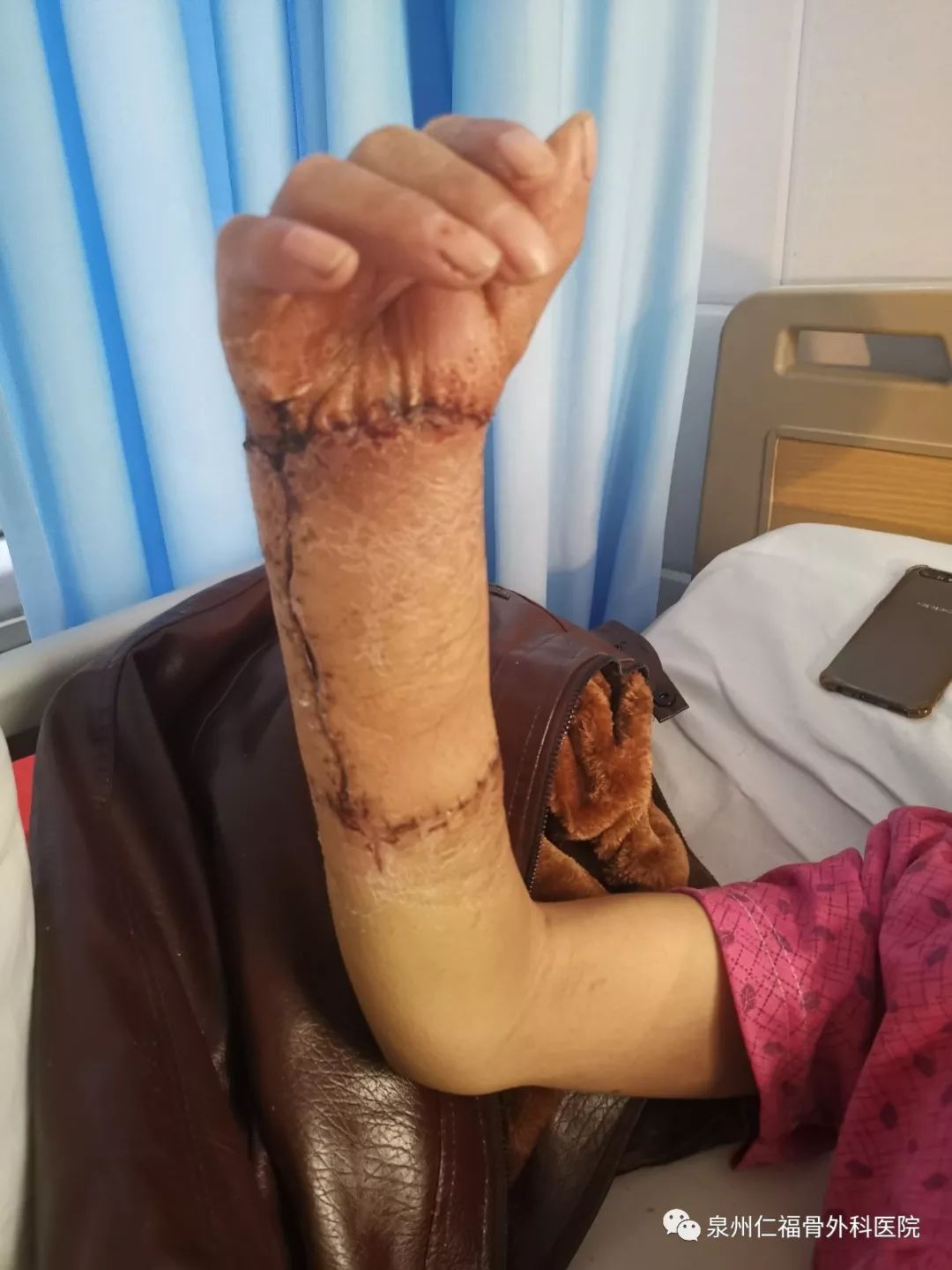 看着失而复得的右手,巫先生感慨道:"这手本来就要被截掉了,能捡个手