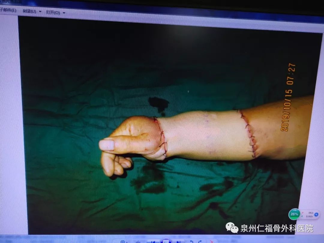 据巫先生的主刀医生庄建龙介绍,当患者送至医院时,其右手腕部伤口裸露