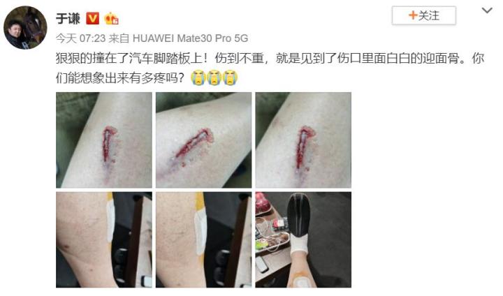 于谦出车祸腿部受伤德云社众演员调侃看着心疼不过腿真白