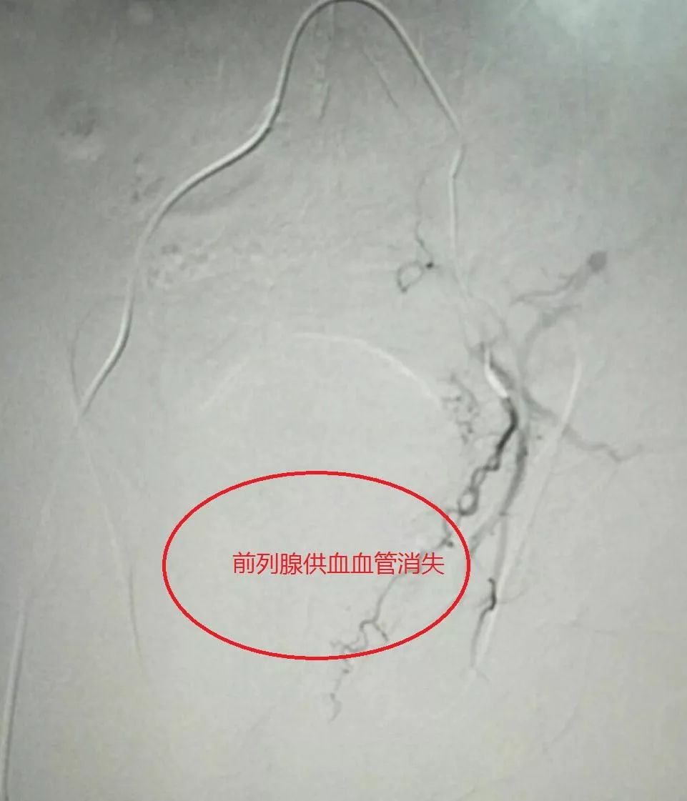 左侧前列腺供血血管栓塞后消失柳州市工人医院副院长,血管介入外科