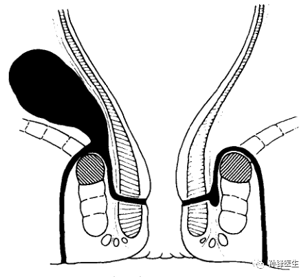 医学干货|史上最全的肛瘘分类(锋哥推荐)_直肠