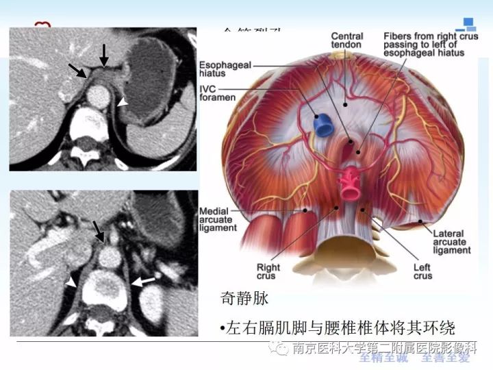 膈肌的解剖及常见病变影像表现