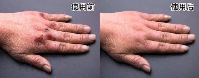 入冬了,年年起冻疮的你还好么?_防冻