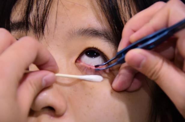 有效解除睑板腺管道阻塞,防止腺泡萎缩,解决大多数患者油脂分泌不足