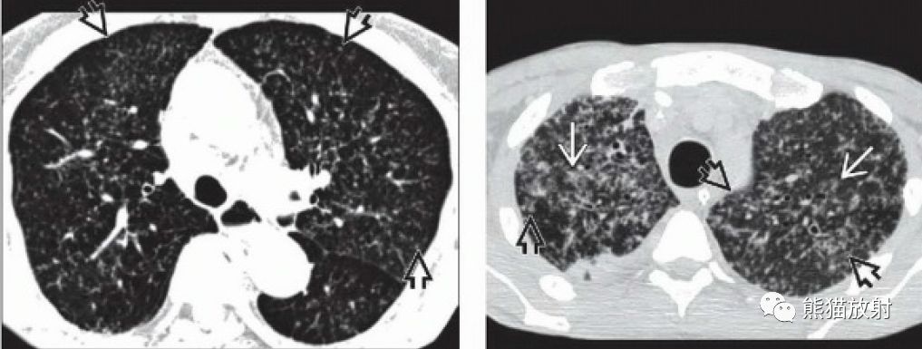 急性粟粒性肺结核图片