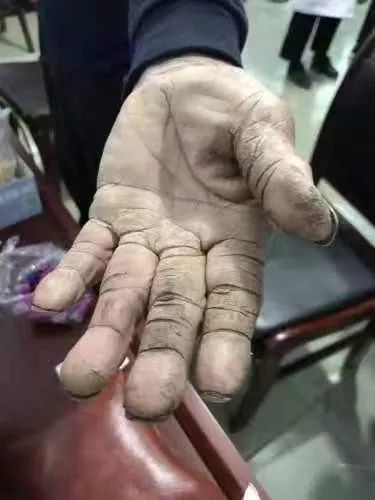 卫辉这位老环卫工人的手让医生流泪了!