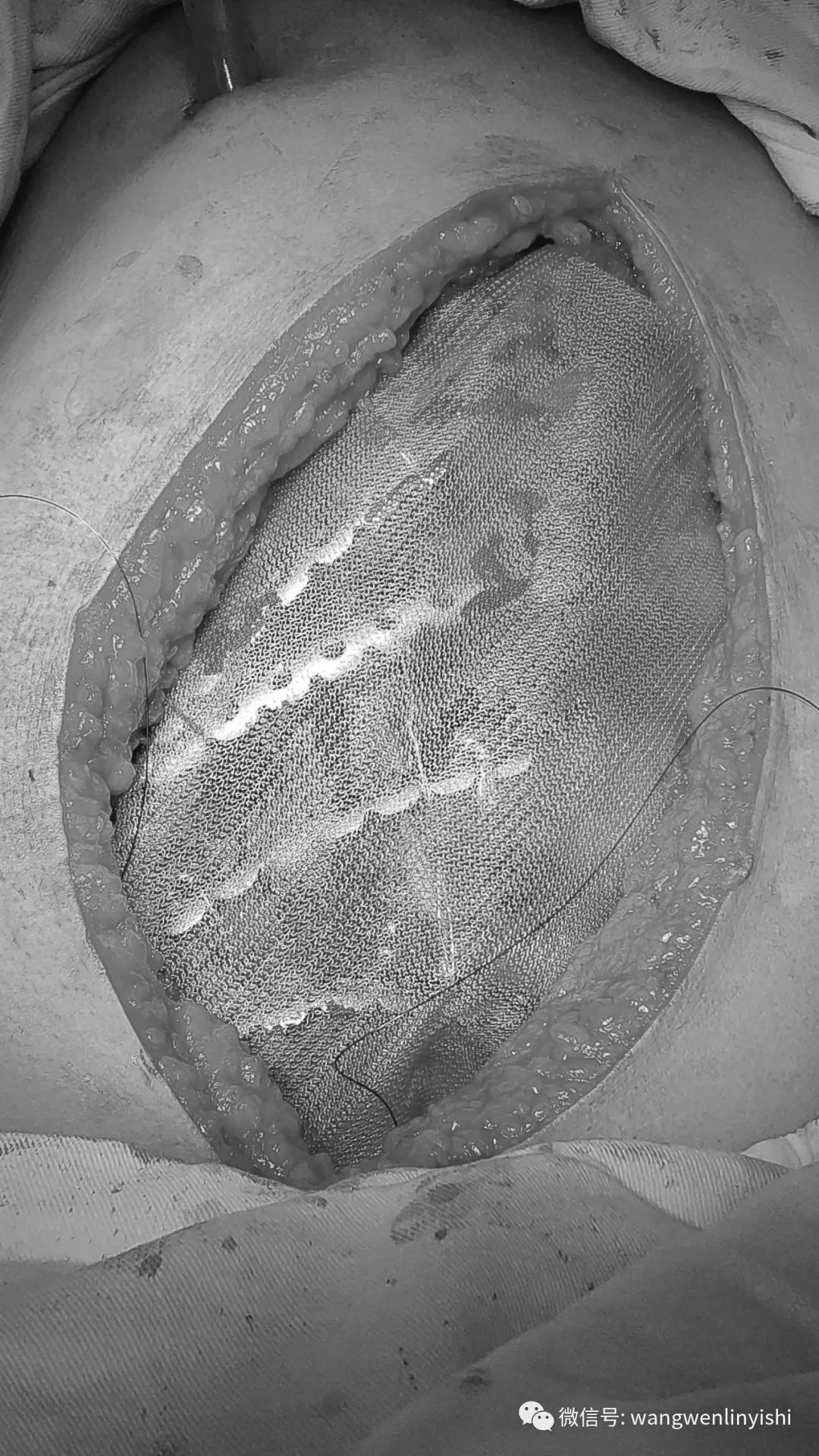 今天手术继发性胸廓畸形脓胸合并胸壁塌陷矫正术