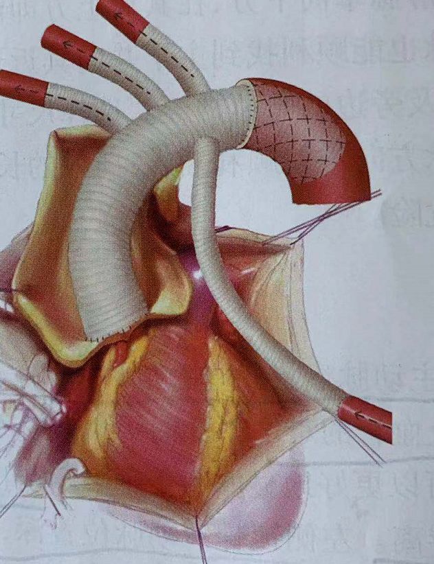 主动脉夹层手术方式图片