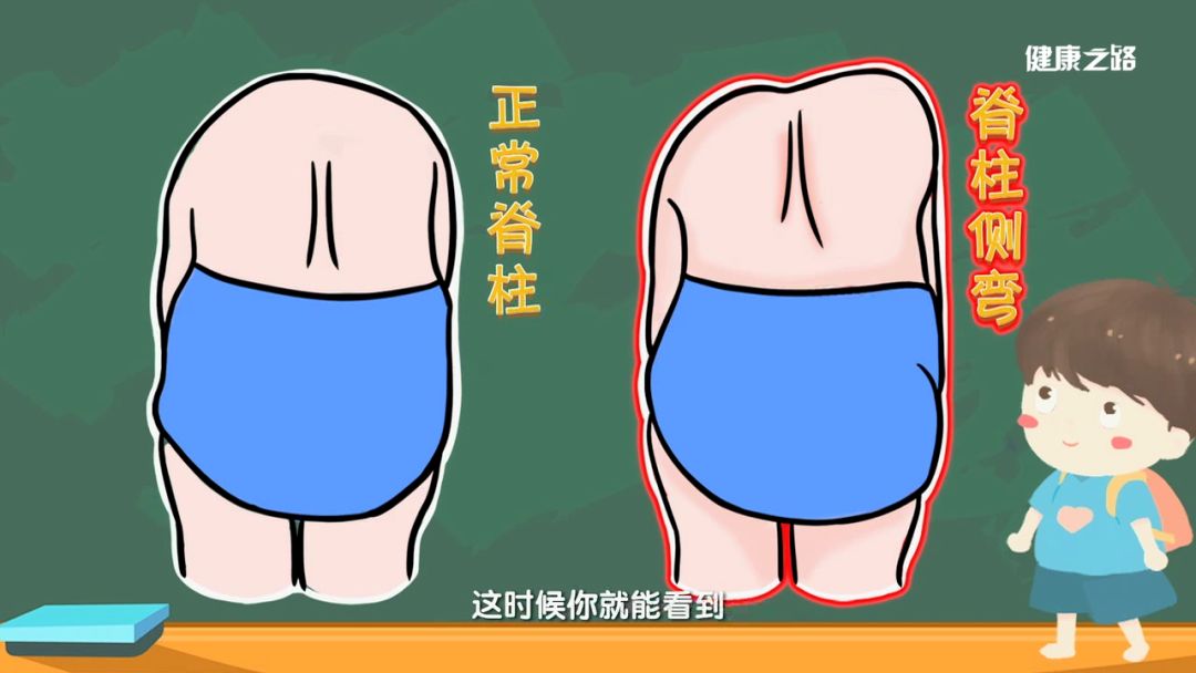 孩子驼背别总是一巴掌拍过去蛮力纠正不如这几招轻松