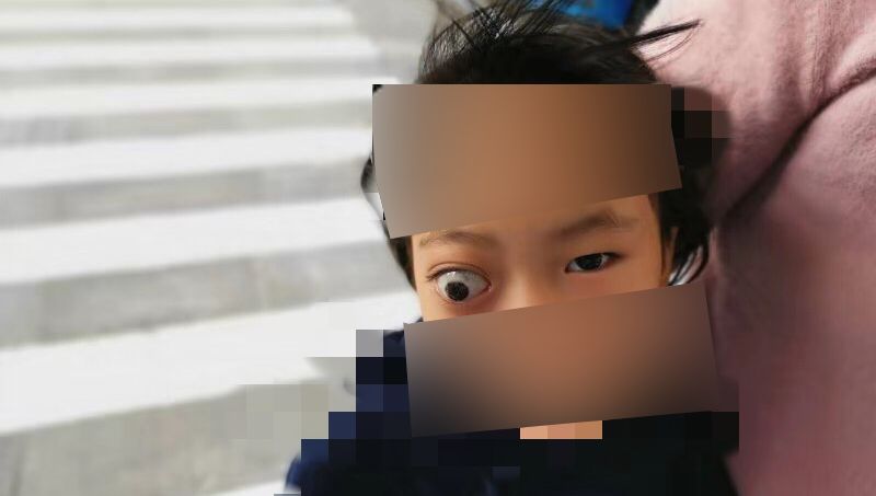 肿瘤已经包绕视神经,手术风险大,完整切除率极低,建议眼球摘除