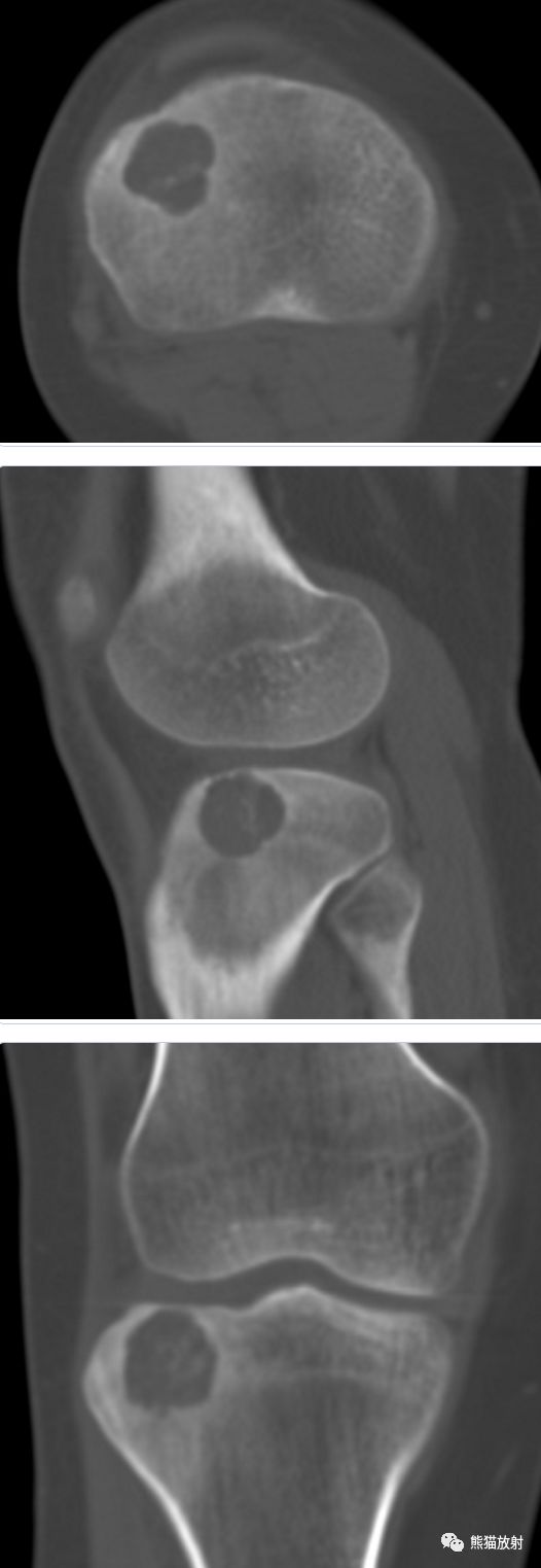 软骨母细胞瘤 chondroblastoma