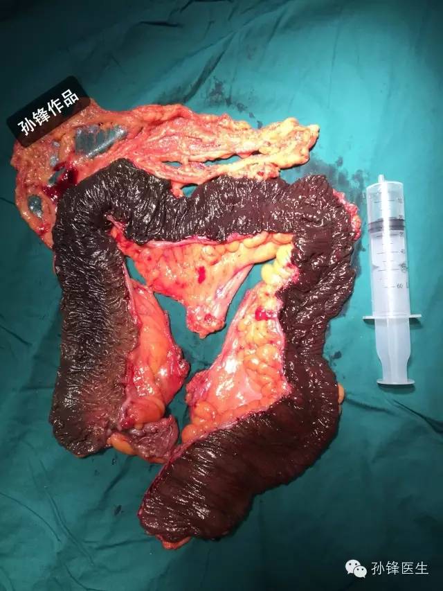 人的肠子真实图片