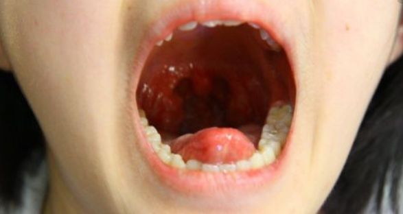 扁桃体炎扁桃体恶性肿瘤多见于男性,男女比为2~3:1.