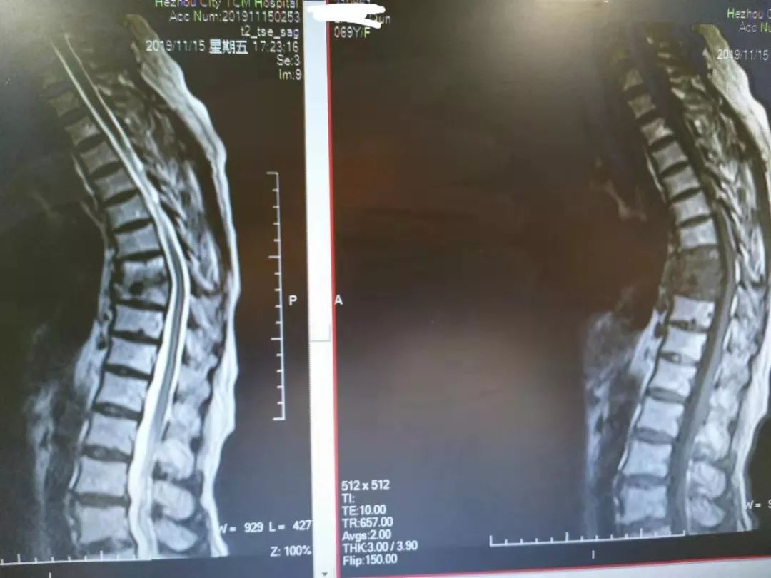 抗结核治疗后3个月,磁共振显示水肿信号改善,有骨性愈合趋势